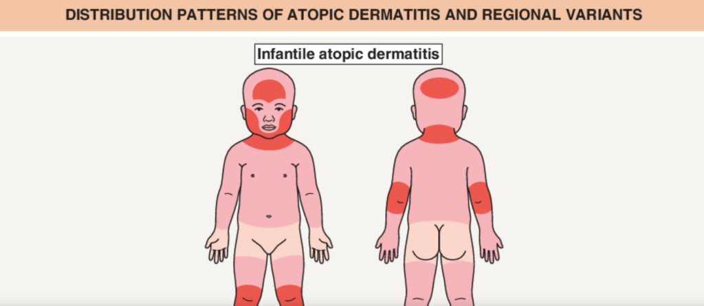 Atopinis dermatitas: tipinės bėrimų vietos