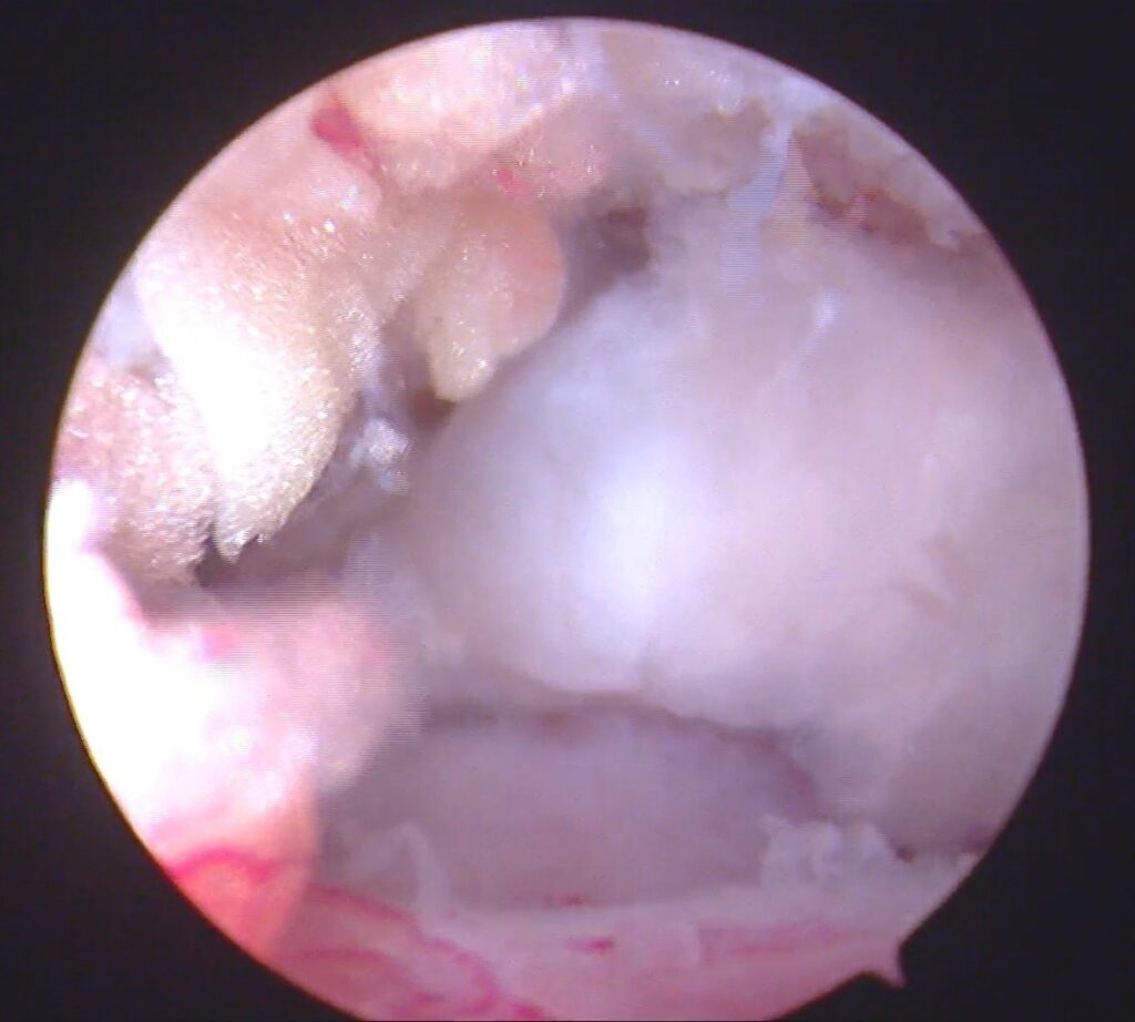 Peties sausgyslių atroskopinė operacija