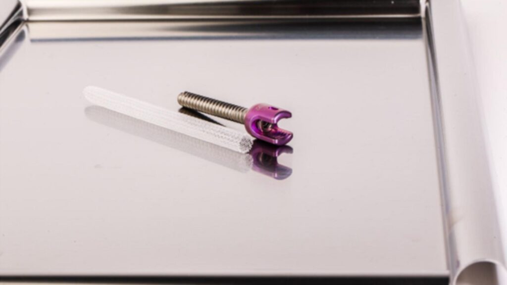 Stuburą sutvirtinantis sraigtas ir specialus „inkarinis” implantas