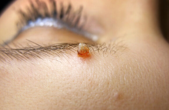 Odos darinys „ant kojelės“: ar būtina šalinti ir kokia grėsmė sveikatai