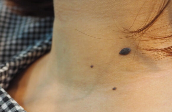Seborėjinę keratozę galima supainioti su piktybine liga: patartina konsultuotis su gydytoju