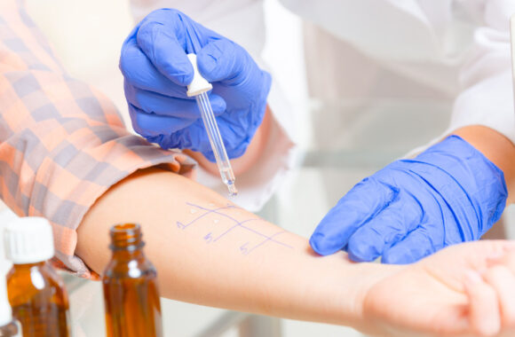 Alergija, alergijos testas