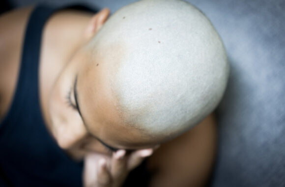 Alopecija – liga, neretai painiojama su vėžiu: jaudinanti paauglės istorija