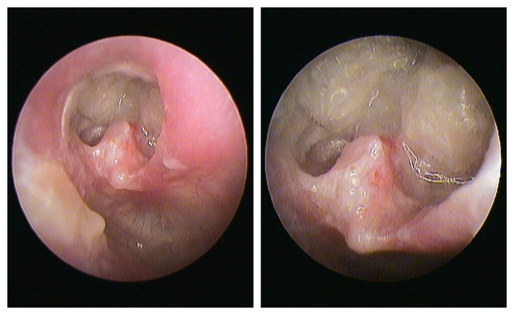 Ausies būgnelis su kraštine perforacija ir užpakalinės kaulinės landos sienos defektu, pro perforaciją stebima cholesteatoma (padidinta)