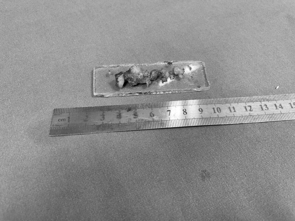 Išplitusi cholesteatoma – pašalinta operacijos metu