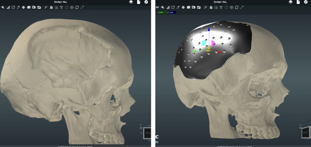 Romualdui individualus kranialinis implantas buvo pagamintas 3D spausdintuvu, naudojant tiesioginio metalo sulydymo lazeriu technologiją iš medicininio titano lydinio. 