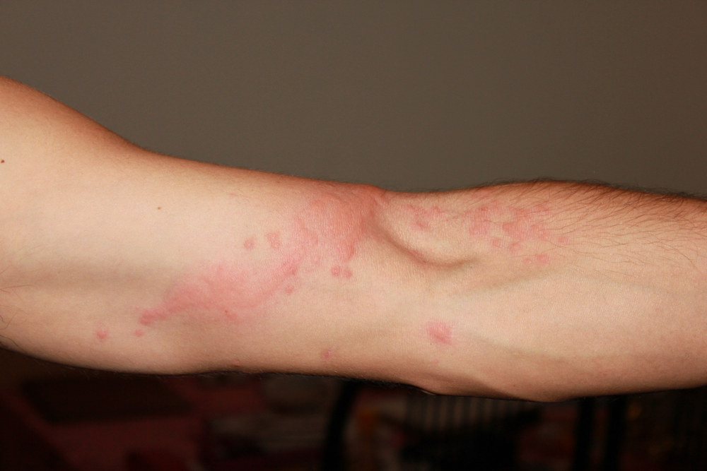 Medūzos įkandimas / Shutterstock nuotr.