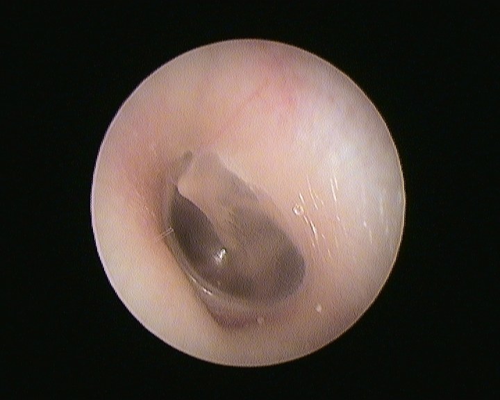 Normalus ausies būgnelis