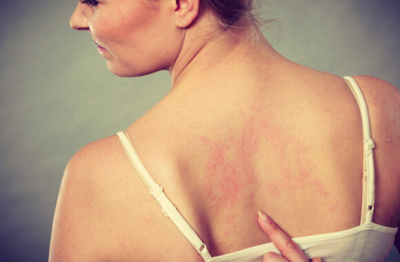 Dilgėlinė: kantrybę išbandanti ir gyvenimo kokybę bloginanti, bet dažniausiai praeinanti liga