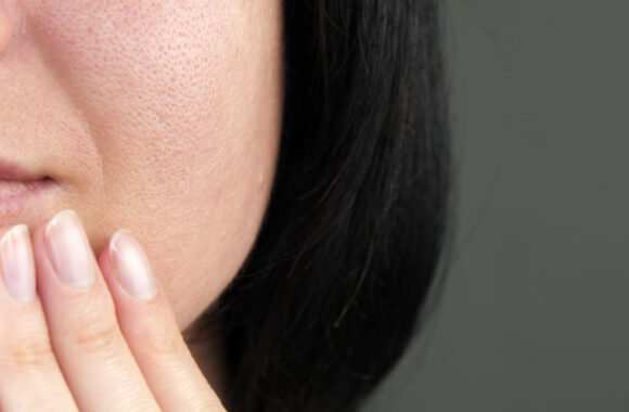 Išsiplėtusios veido poros: specialistė paaiškino, ko vengti prižiūrint odą