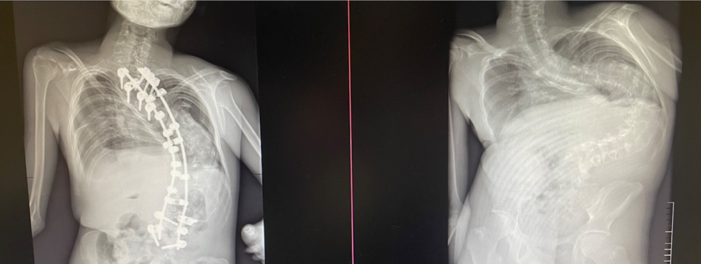 Prieš ir po stuburo operacijos