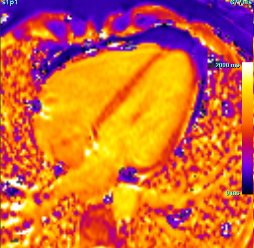 Širdies parametrinis žemėlapis (1)