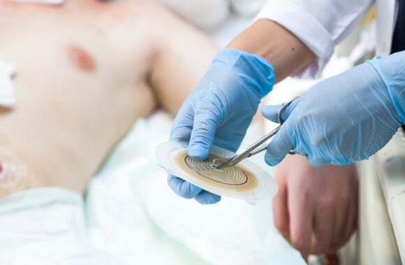 Gyvenimas su stoma – sunkiausia įveikti psichologinį diskomfortą