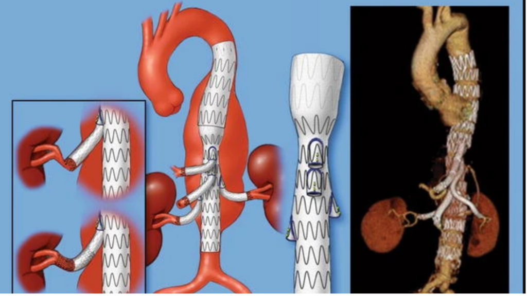 Aortos padengimas stengraftu