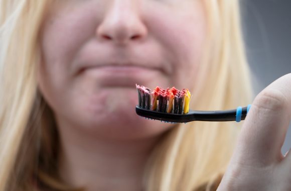 Kraujuoja dantenos - ką daryti?