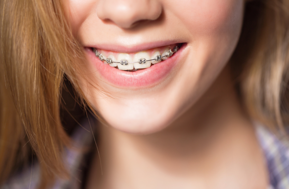 Dantų tiesinimas breketais