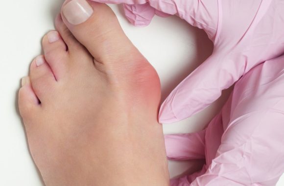 Iššokęs pėdos kauliukas