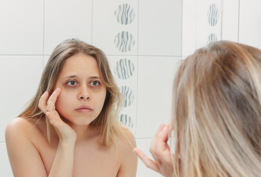 Pajuodę paakiai; tamsūs ratilai aplink akis