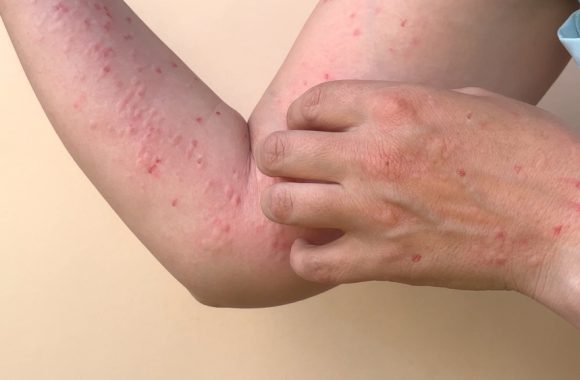 Beždžionių raupai