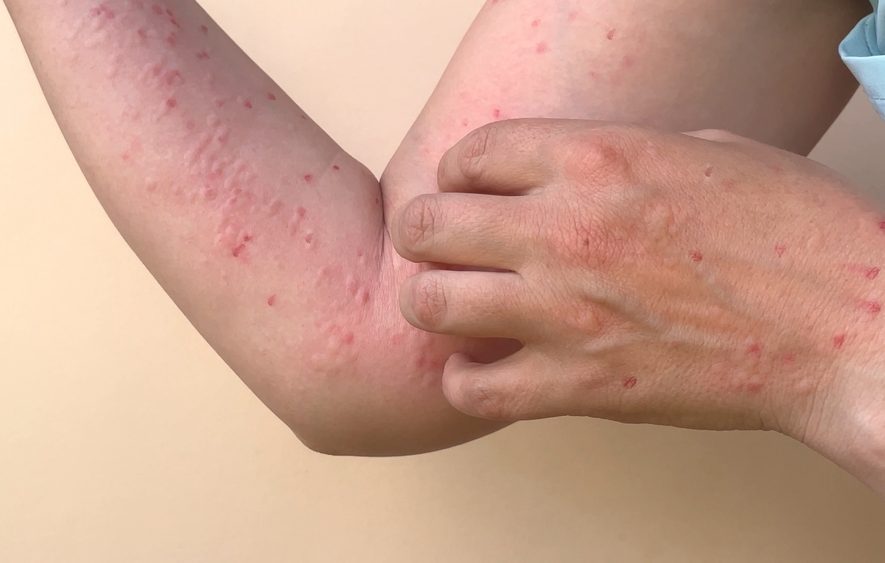 Beždžionių raupai