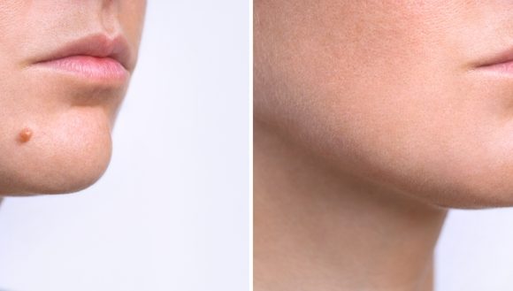 Apgamų šalinimas Surgitron technologija