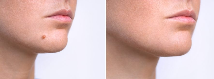 Apgamų šalinimas Surgitron technologija