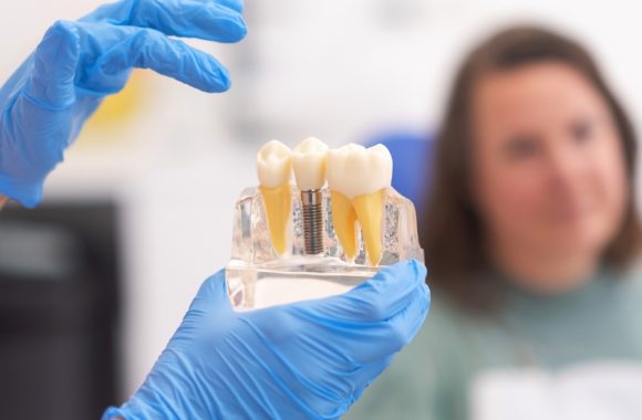 Ką reikėtų žinoti apie dantų implantaciją?