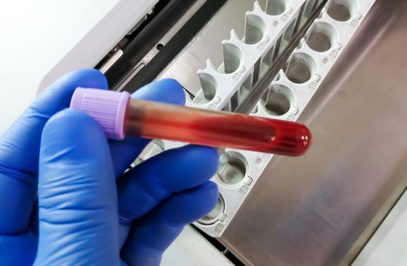 Lėtinė mieloleukemija (LML)