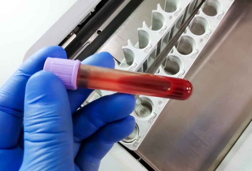 Lėtinė mieloleukemija (LML)