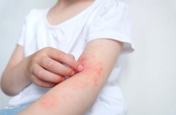 Atopinio dermatito gydymas liaudiškai – ką sako natūralios medicinos šalininkai?
