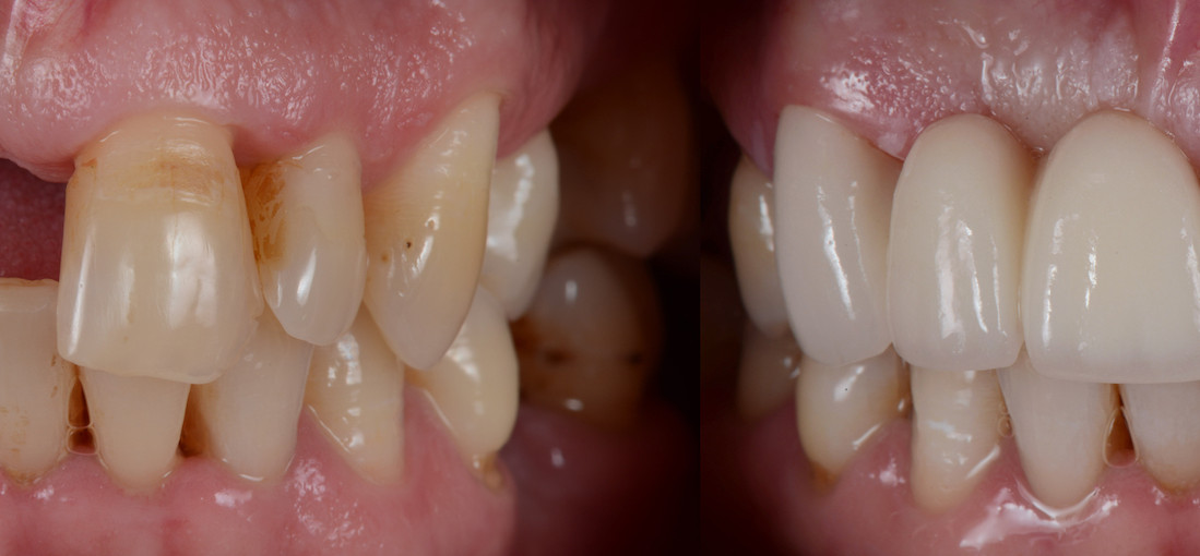 Dantų protezavimas: prieš ir po