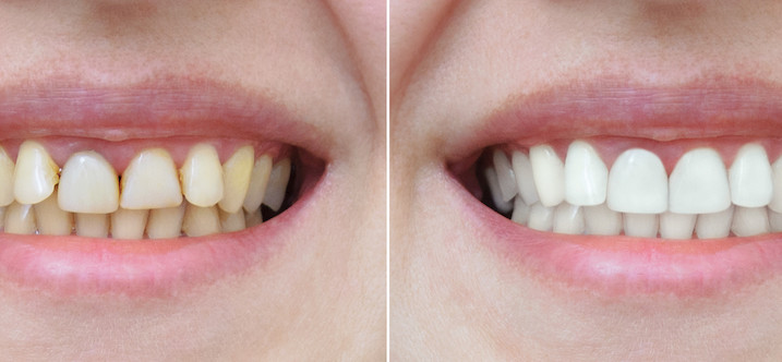 Estetinis plombavimas: prieš ir po