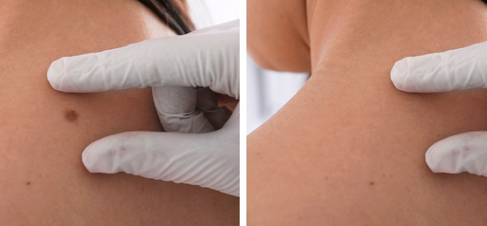 Moteris po apgamo pašalinimo procedūros