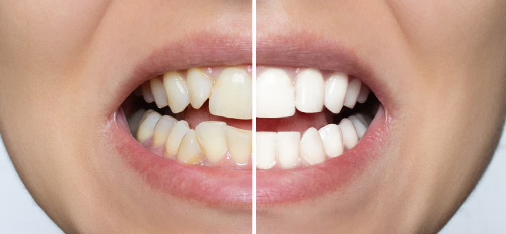 Pokyčiai po dantų tiesinimo