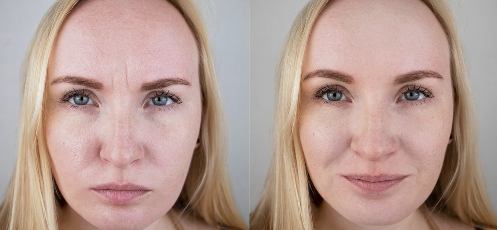 Odos pokyčiai prieš ir po mezoterapijos kurso