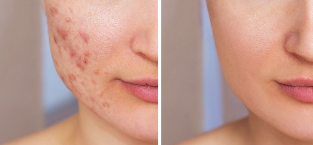 Veido odos pokyčiai prieš ir po aknės gydymo