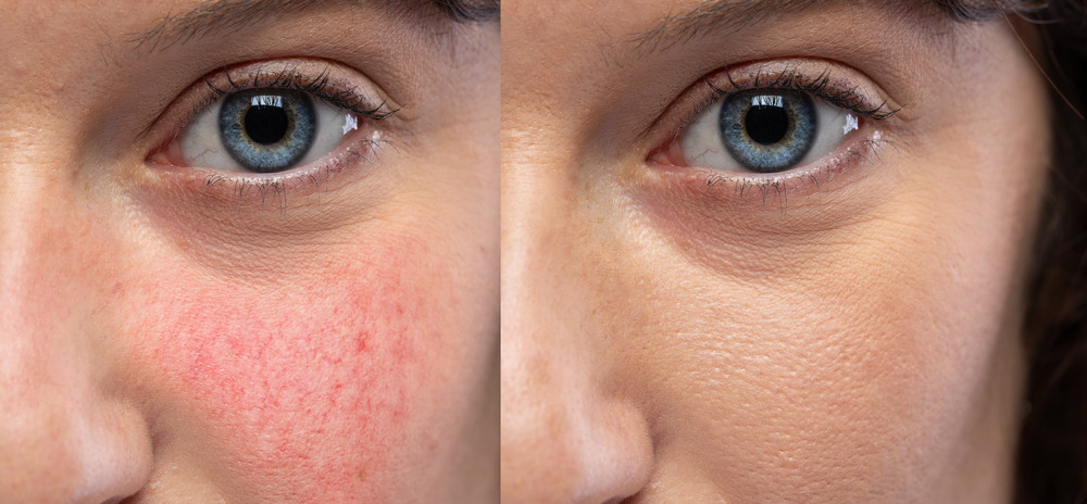 Moteriai atliktas kapiliarų šalinimas lazeriu