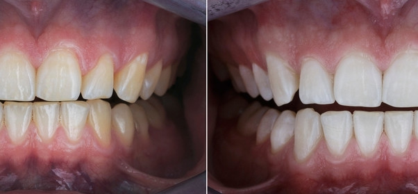 Dantų balinimas: prieš ir po