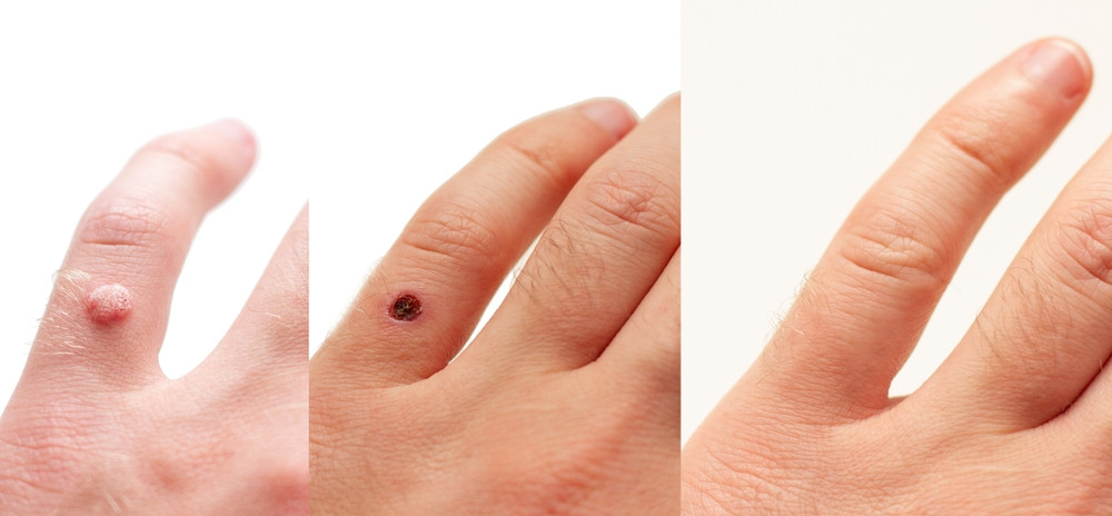 Karpų šalinimas lazeriu: prieš ir po